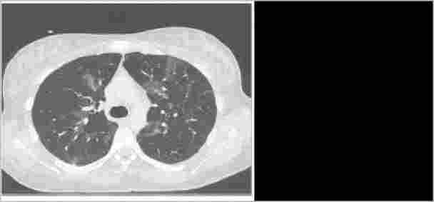 抽電子煙抽出肺泡